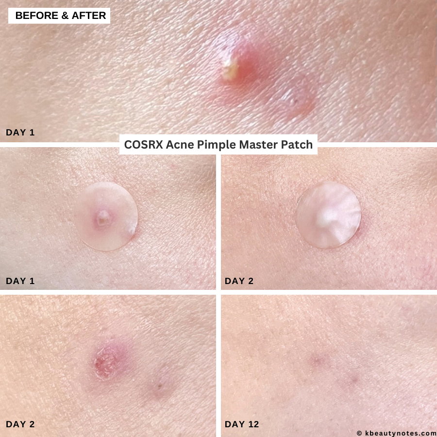 “AcneClear™ Pimple Patches (Invisible & Fast Healing)”